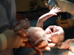 Chapa Cesarean Section Gallery